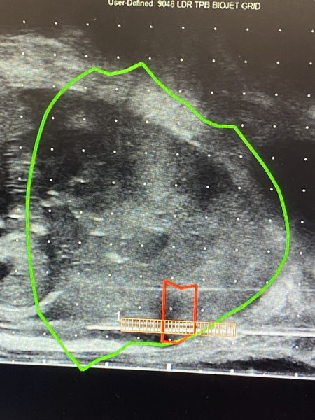 Theatre setup for transperineal MRI fusion biopsy