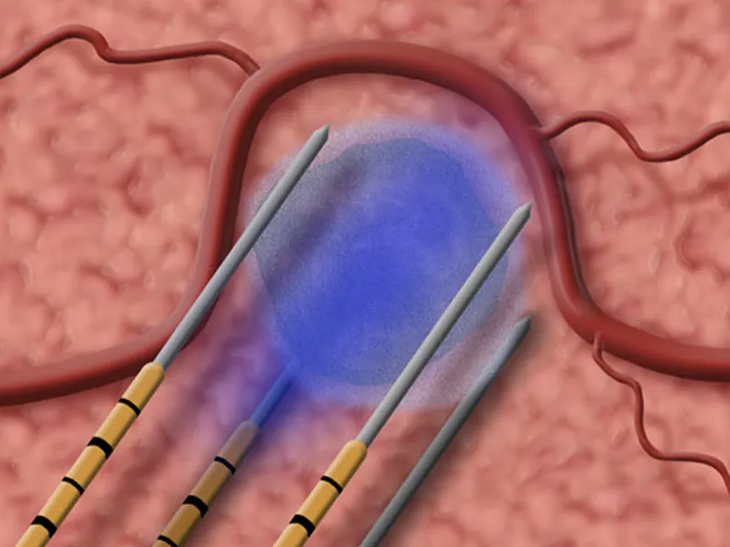 NanoKnife Irreversible Electroporation illustration