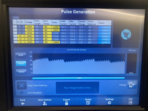 NanoKnife pulse generator during treatment