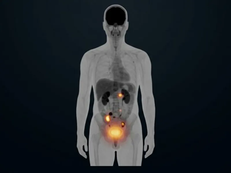 PSMA PET/CT scan showing tracer uptake hot-spots