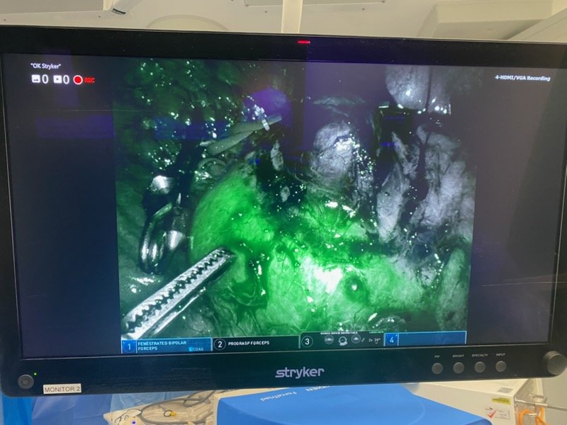 Robotic partial nephrectomy - indocyanine-green (ICG) fluorescence view on the operating-room monitor, showing renal perfusion in green during the procedure