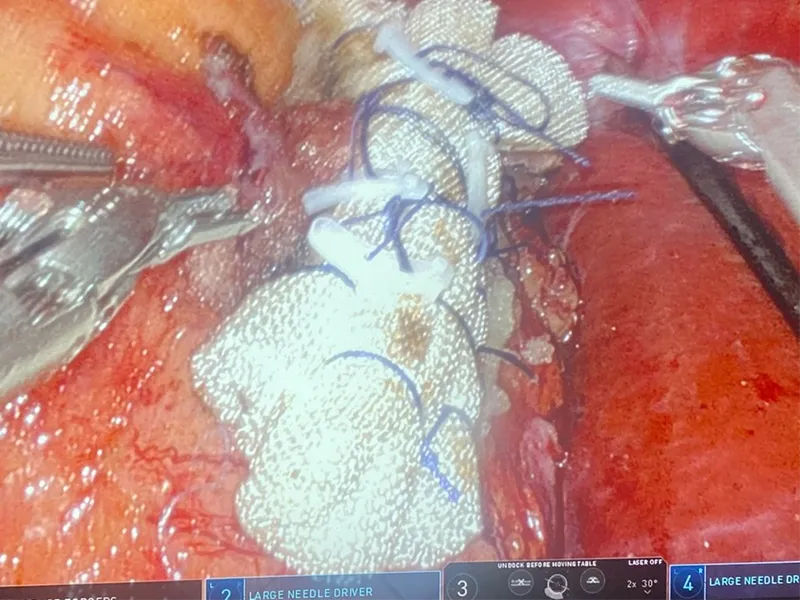 Robotic partial nephrectomy intraoperative view - kidney parenchyma being closed over a haemostatic bolster, da Vinci instrument labels visible at the foot of the surgeon-console image