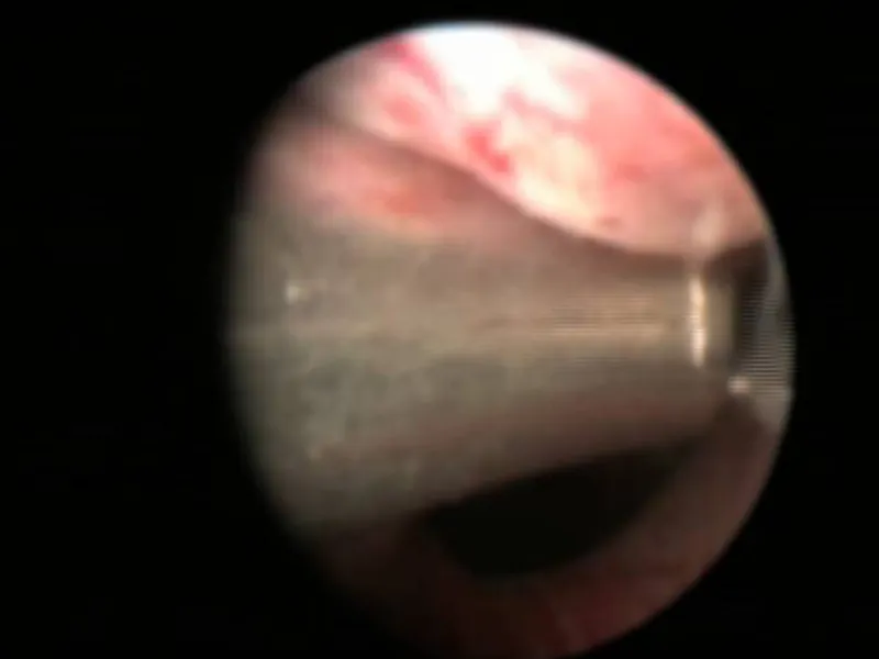 UroLift procedure video