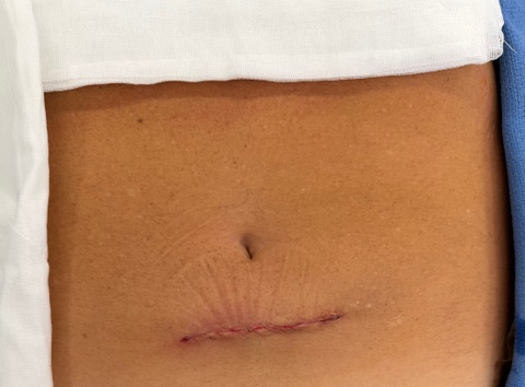 Final result of the Single Port procedure - single suprapubic incision