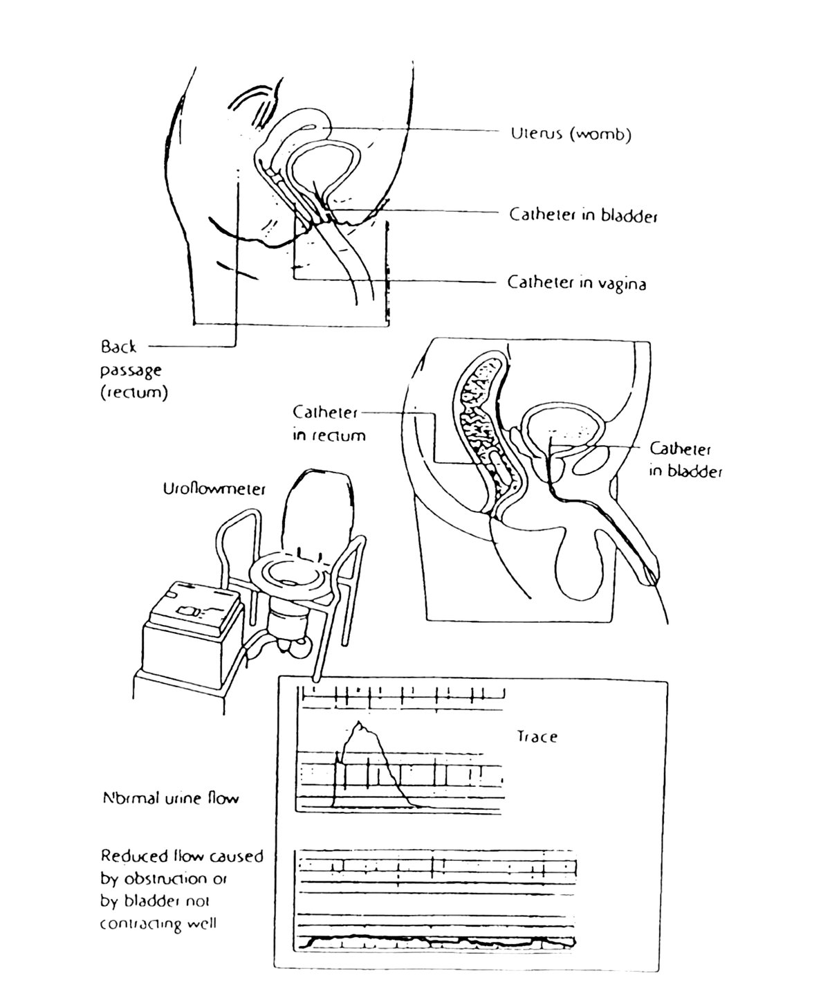 Line diagrams of a three-channel cystometry urodynamic study: catheter positions in the bladder and vagina in a woman, catheter positions in the bladder and rectum in a man, a uroflowmeter, and example flow traces showing a normal urine flow curve and a reduced flow curve