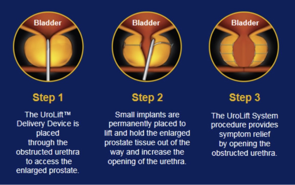 How UroLift works: diagram showing the UroLift implant holding the obstructing prostate lobe aside to open the urinary channel